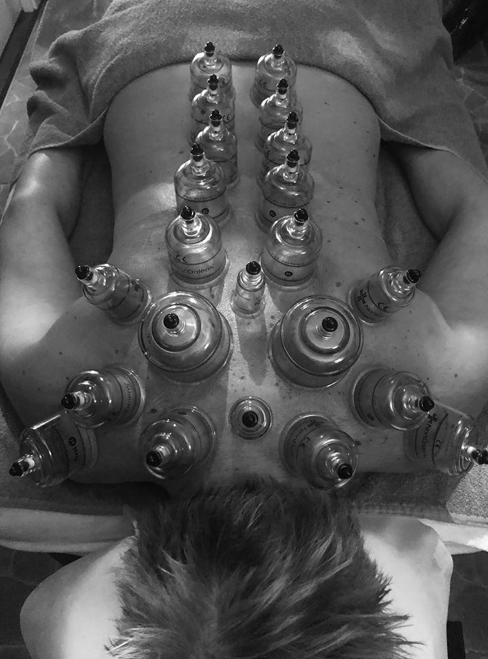 Cupping Therapie